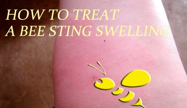 How to Treat a Bee Sting Swelling Fast