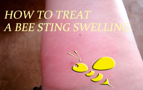 how to reduce swelling on face after bee sting